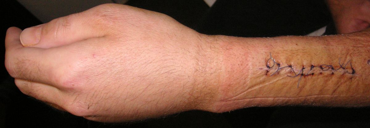 Hand mit Unterarmwunde